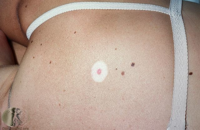 nevus halonevus