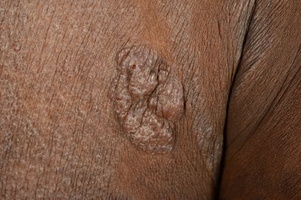 Foto af mycosis fungoides i tumor-stadie