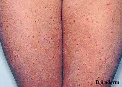 Psoriasis-guttat