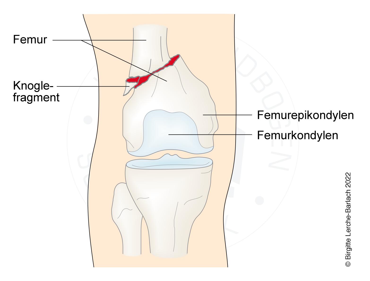 laar-fraktur suprakondylaer femoris 7321