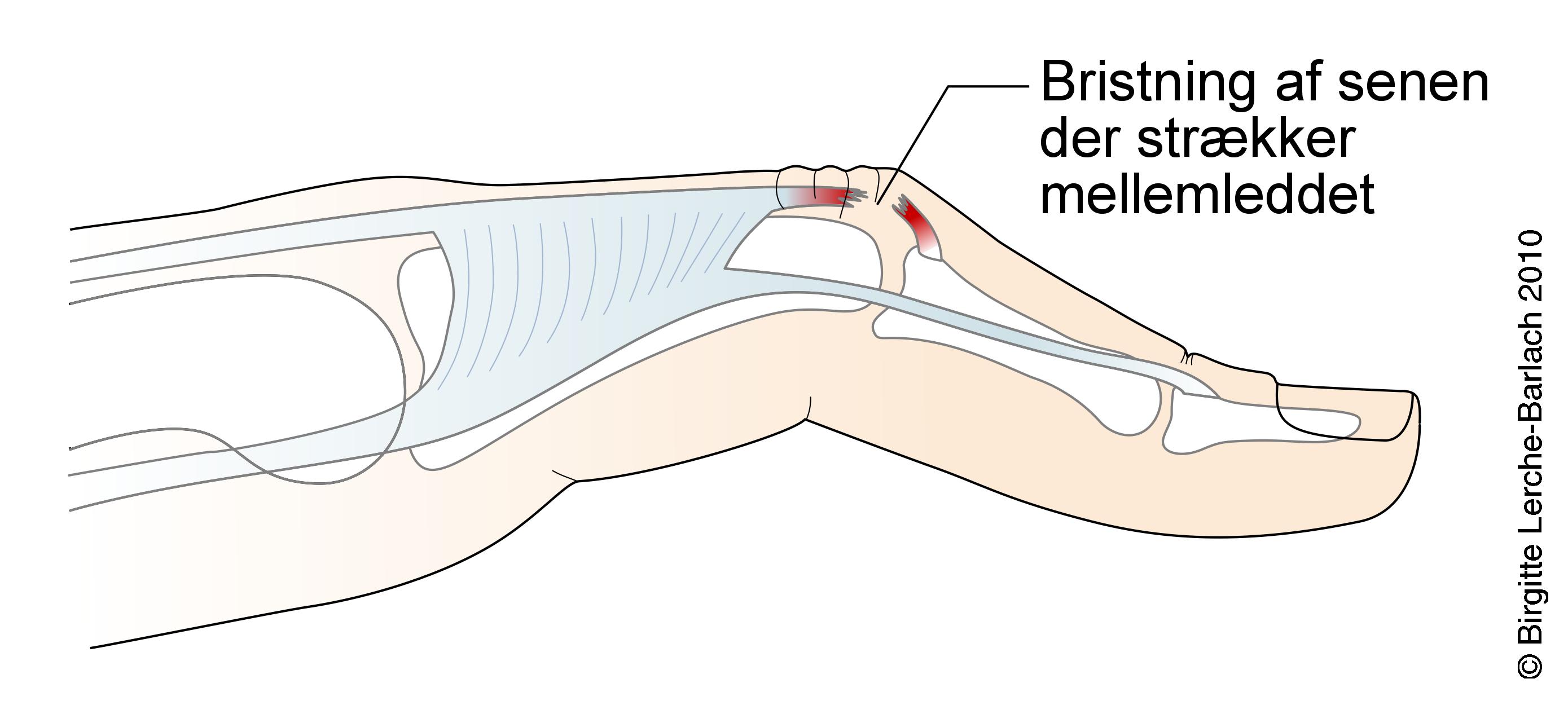 finger-ruptur tend m ex