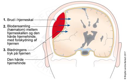 Epiduralt hæmatom, tegning.