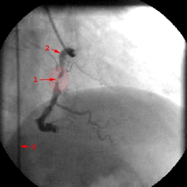 stenose rca-roentgen