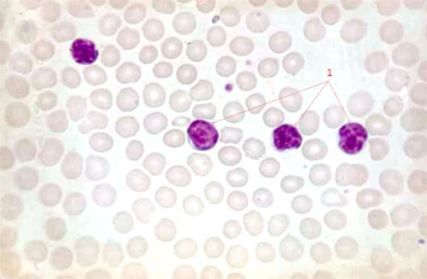 blod-kronisk lymfatisk leukemi x 40