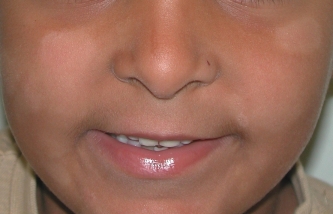 pityriasis alba