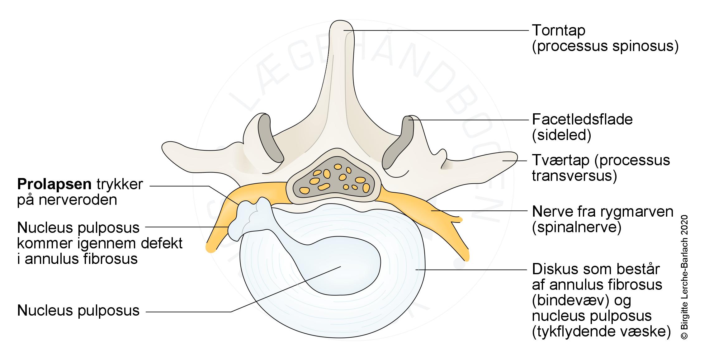 rygsoejle-Lumbal disskusprolaps  tvaersnit