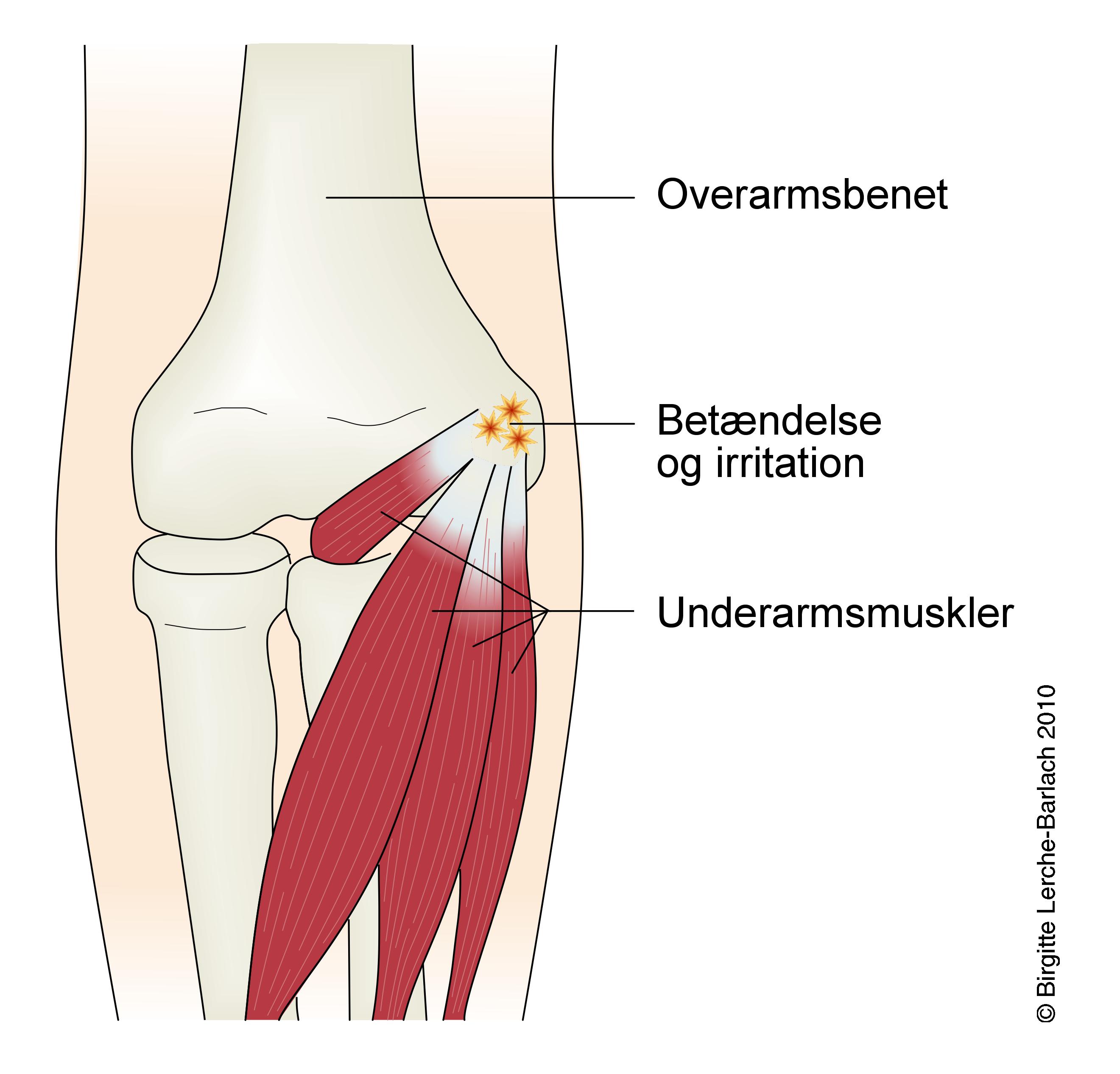 albue-medial epikondylitis