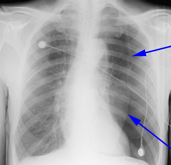 lunger-pneumothorax spontan-roentgen