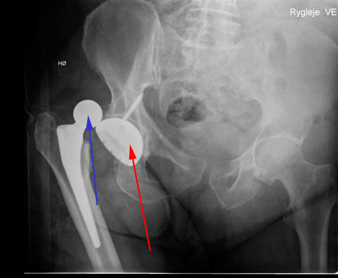 hofte-fuld hofteprotese gaaet af led-roentgen