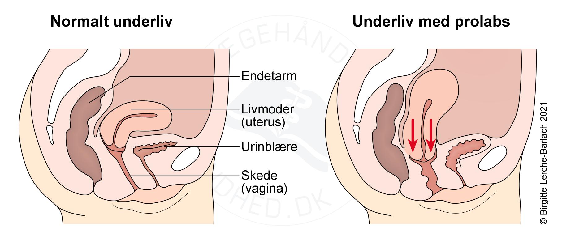 livmoder-uterusdescens moderat