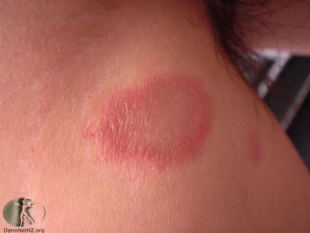 pityriasis rosea herald patch