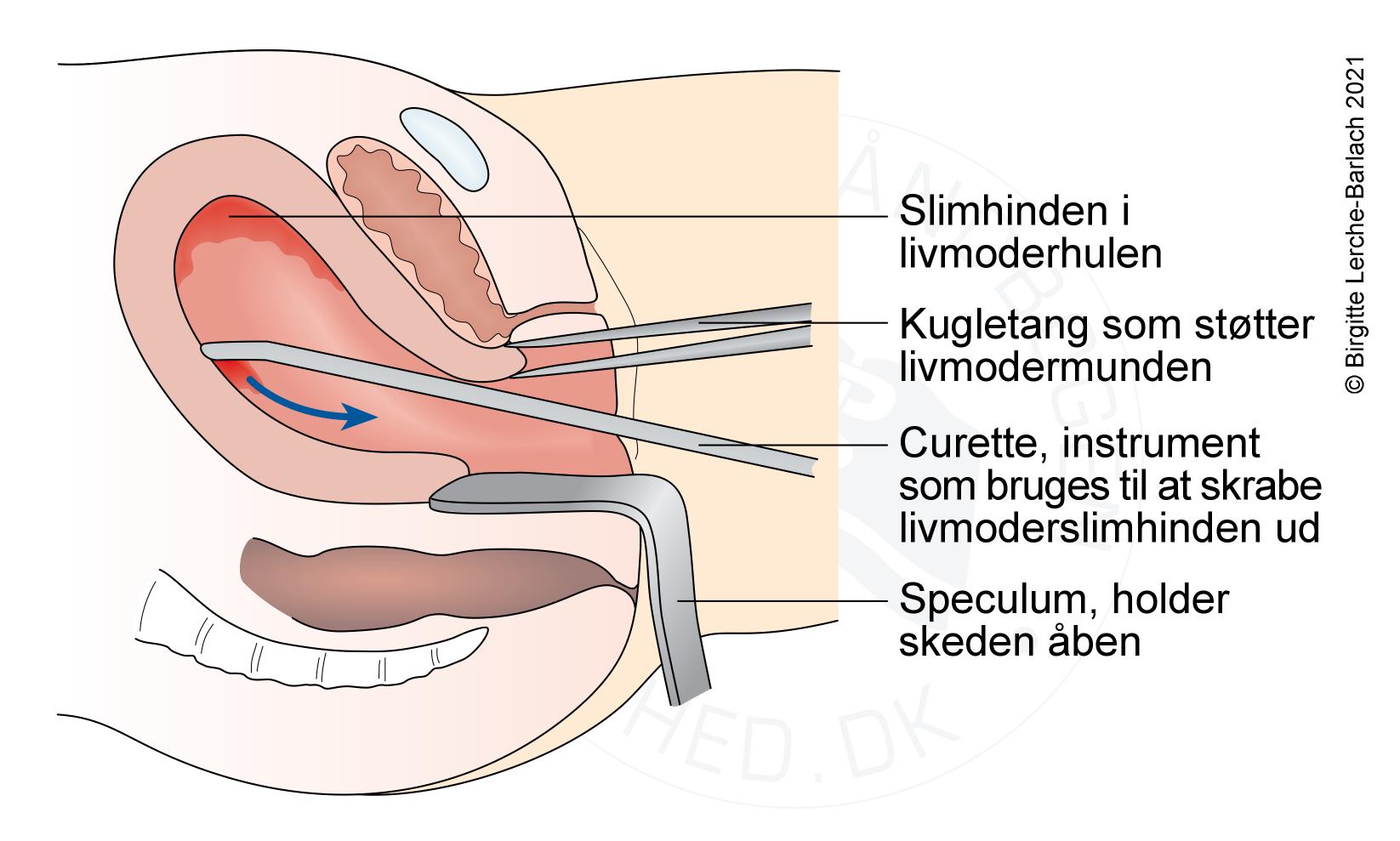 livmoder-abrasio udskrabning