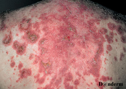 subakut-lupus-erythematosus