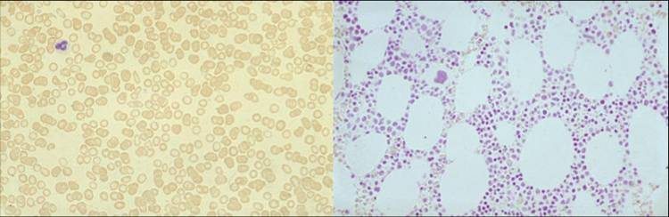 jerntom knoglemarv-mikroskopi