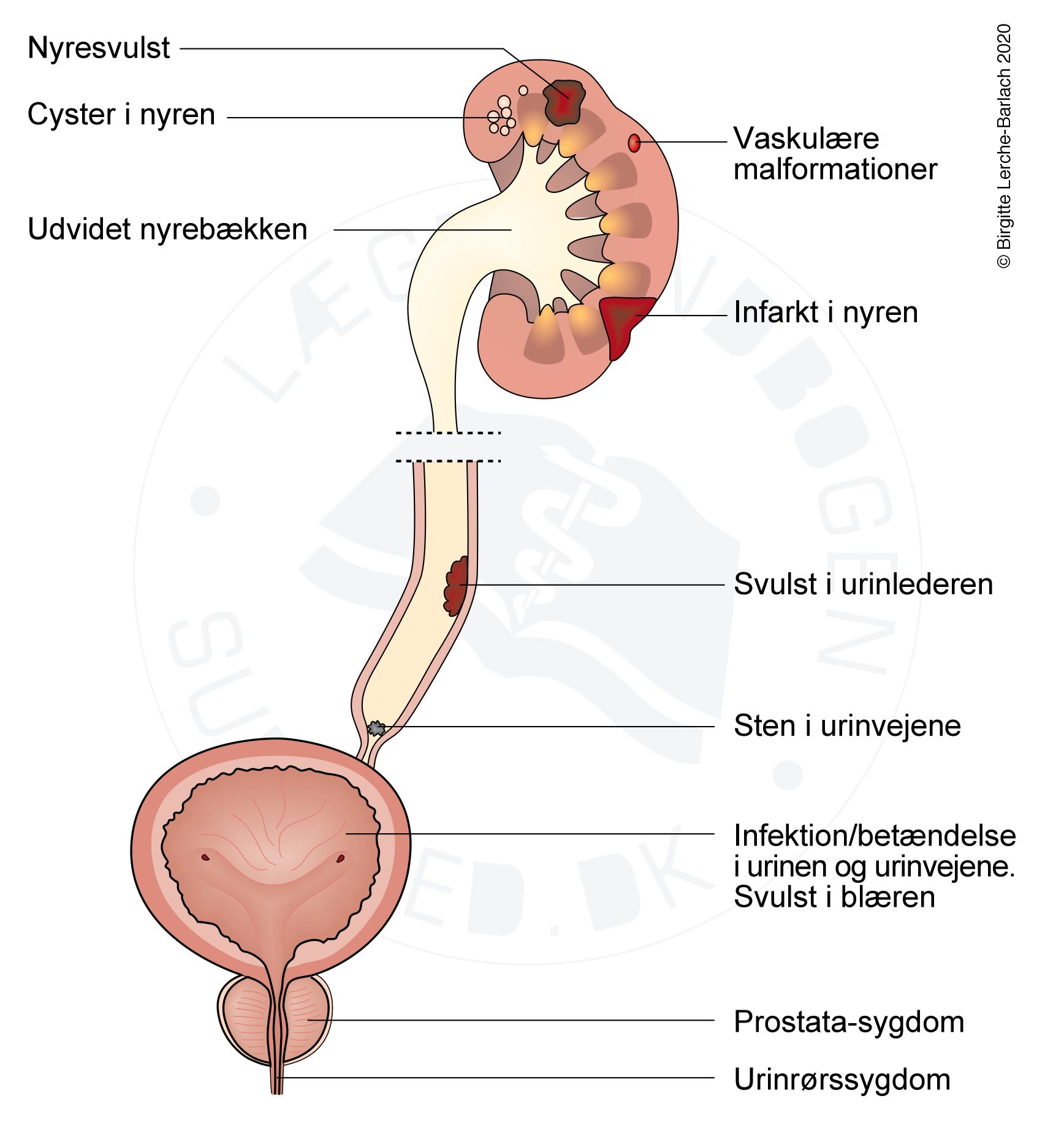 nyre-haematuri aarsager