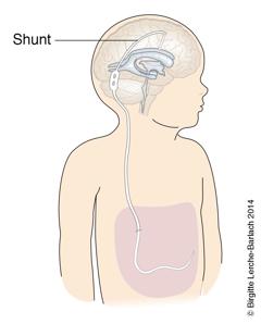 hydrocephalus-shunt, tegning.
