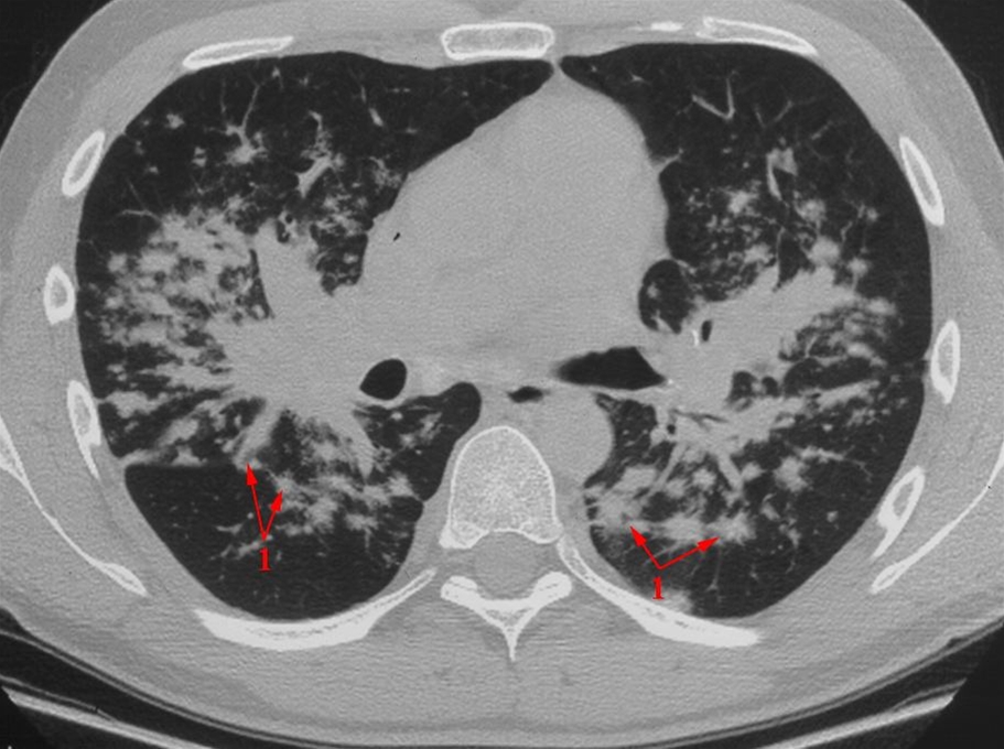 lunger-sarkoidose-ct