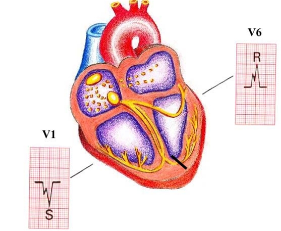 hjerte-venstre grenblok-ekg