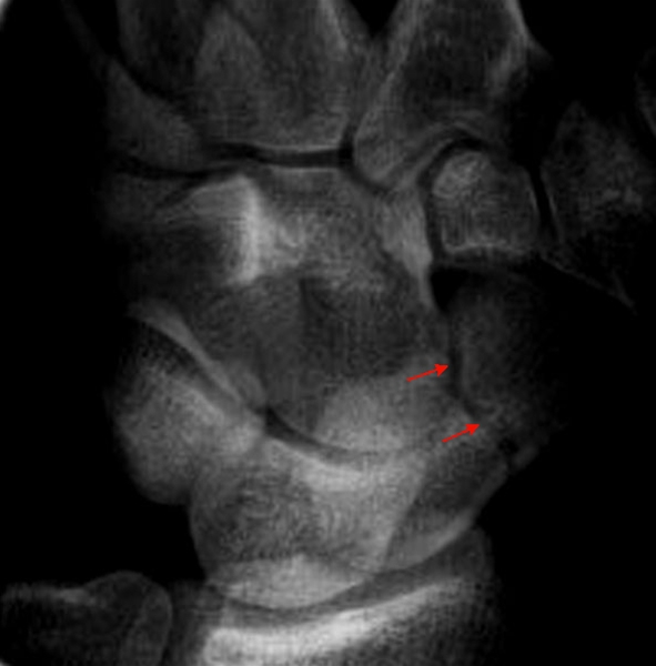 haand-schaphoidfraktur-roentgen