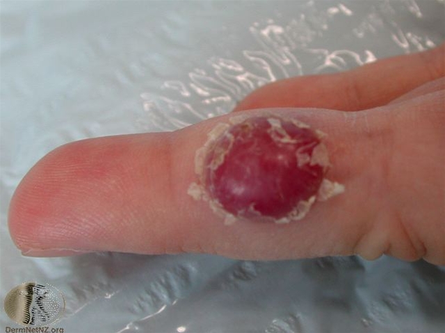 pyogent granulom finger