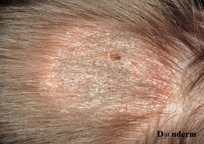 Tinea capitis caused by Microsporum canis
