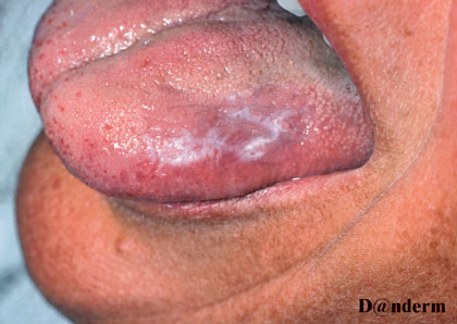 Lichen-planus-oral