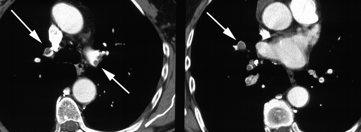 lunger-lungeemboli-ct