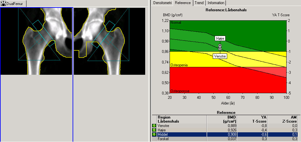 ryg-normale hofter dxa