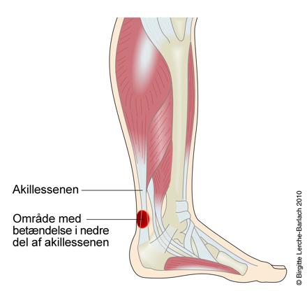 Område med betændelse i nedre del af akillessenen, det er bagside af ankel, lige over hæl.