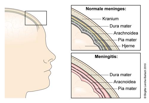 Meningitis anatomi hovedet.