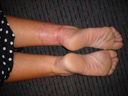 tinea corporis-1-ben
