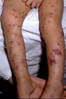 Foto af Hudblødninger (petekkier) ved hjernehindebetændelse (meningitis).