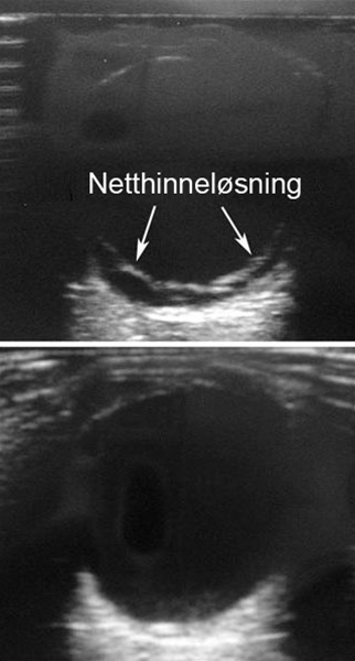 oeje-netthinneloesning-ultralyd