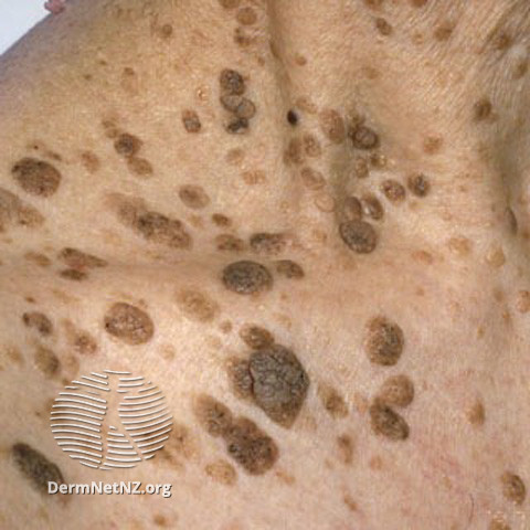 serboroiske vorter krop 50456