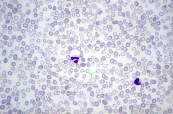 jernmangelanemi-celledyrkning