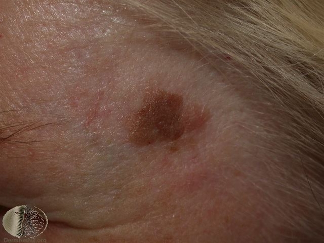 4200 2 seboroiske vorter 4 jpg