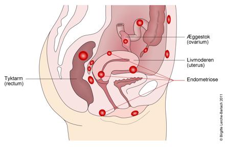 Tegning af livmoder endometriose lokalisationer.