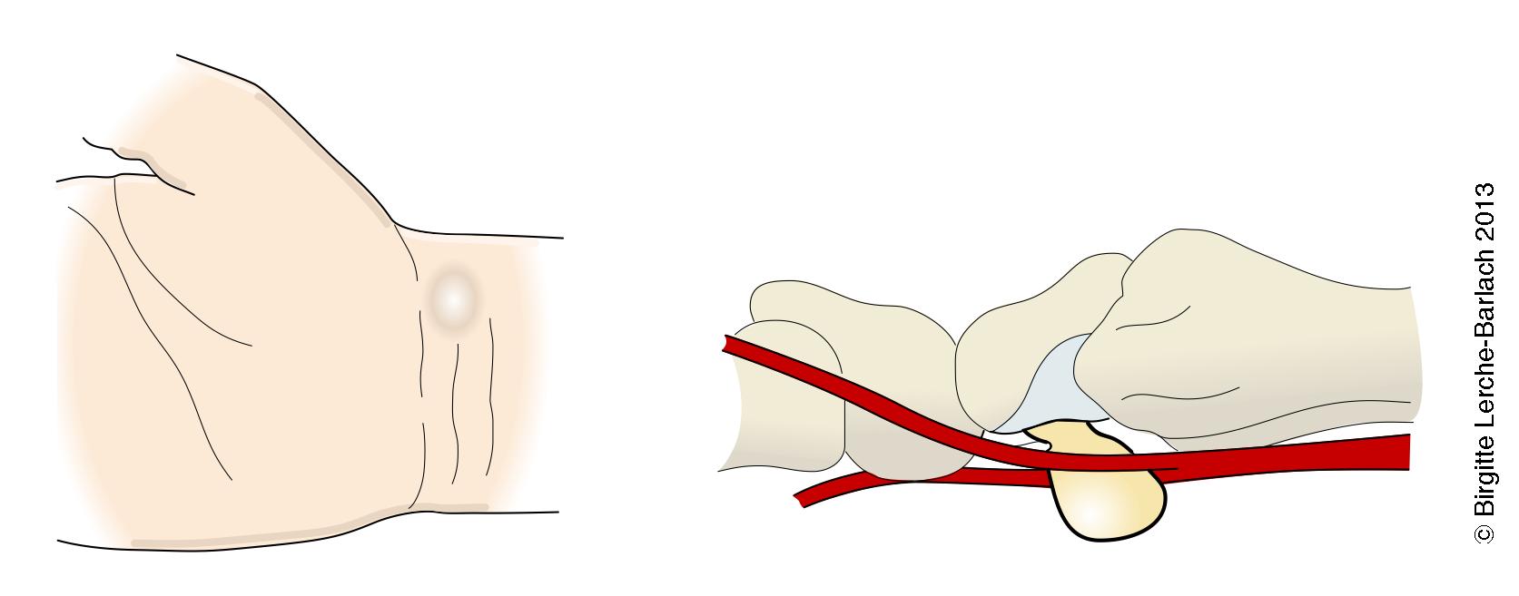 haand-volare haandledsganglion jpg