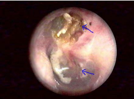 Flaccida, choleastom. Billede venligst udlånt af: Patrick Aïdan, M.D. (ORL), Hôpital Beaujon.