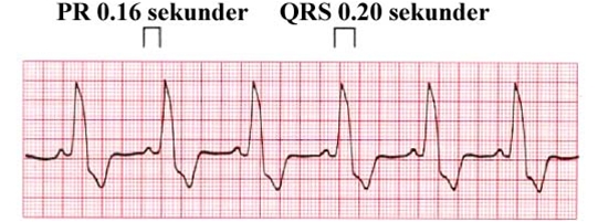 qrs kompleks