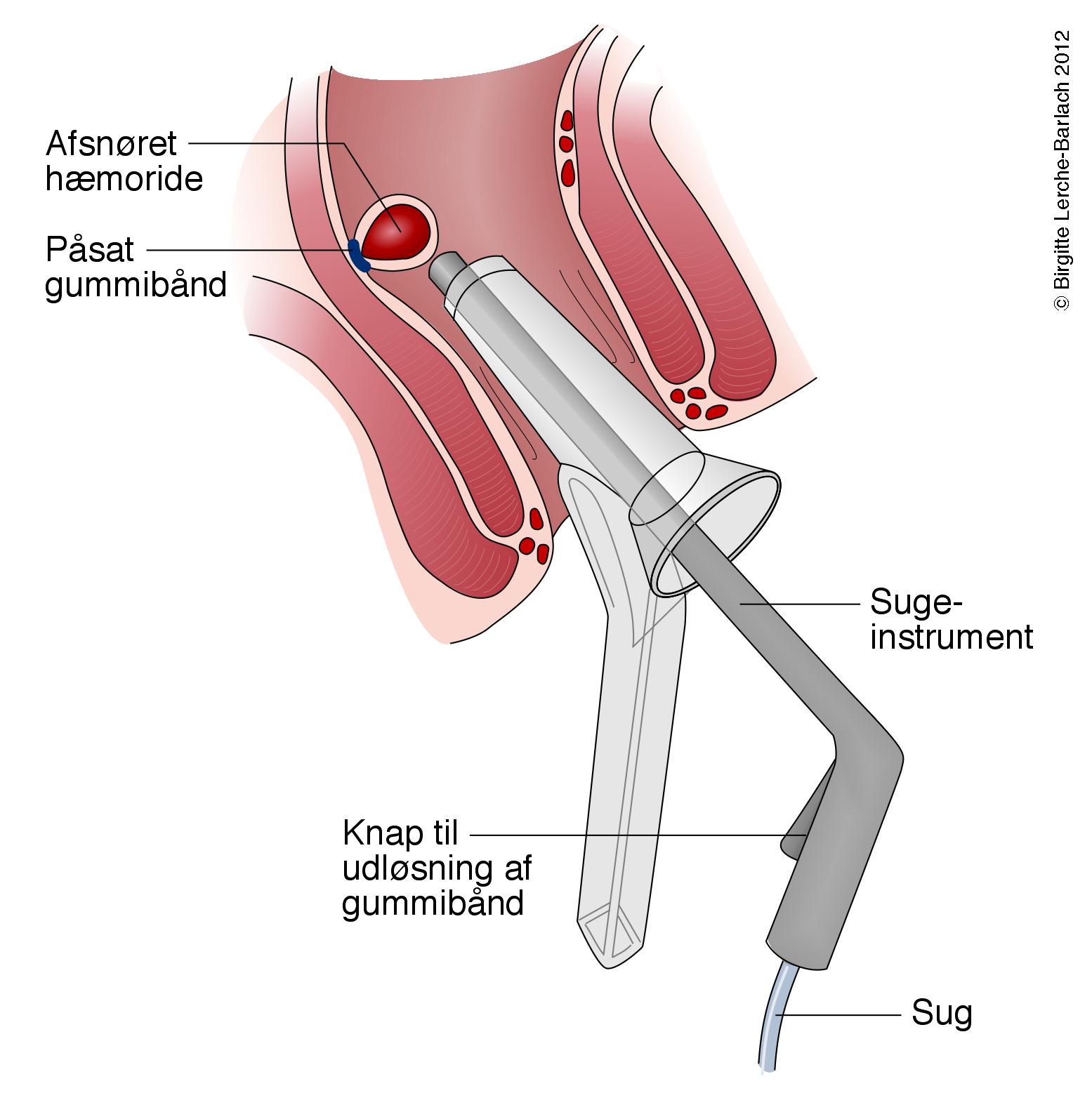 rektum- elastikbehandling af haemoride