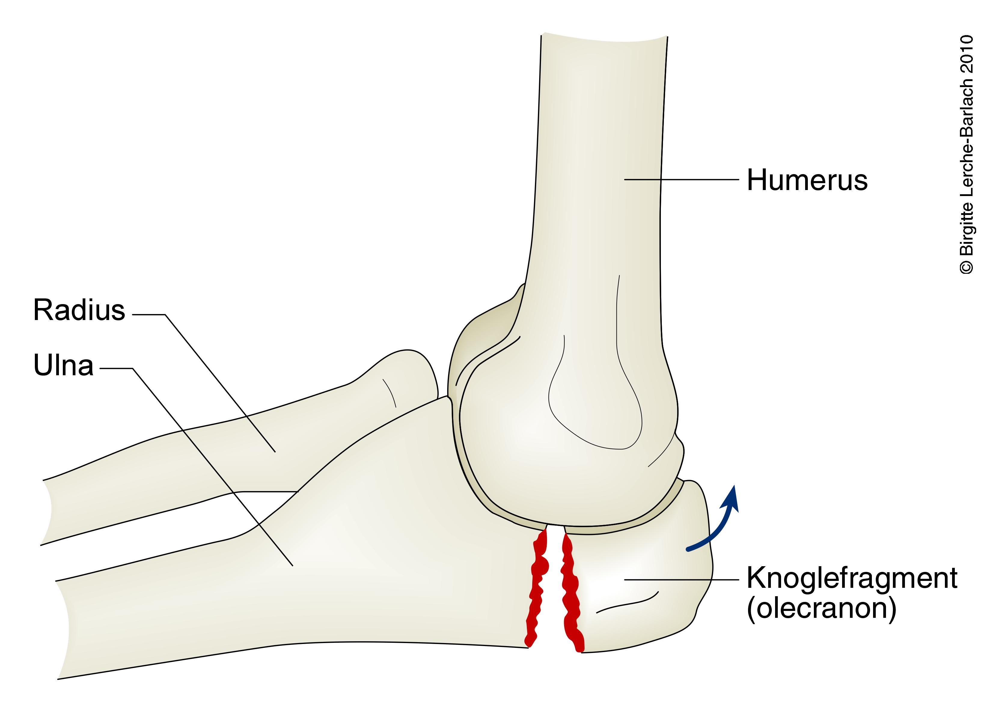 underarm-fraktur af ulna 2