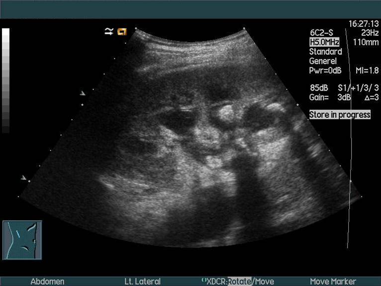 nyre pyonephrose ultralyd