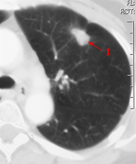 lunger-lungecancer-ct