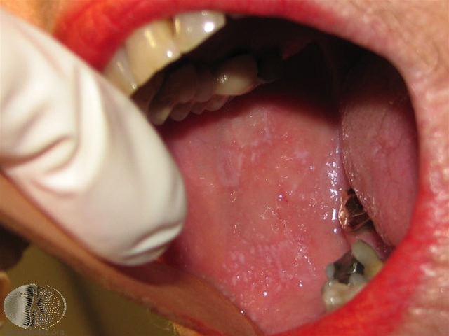 lichen planus oral