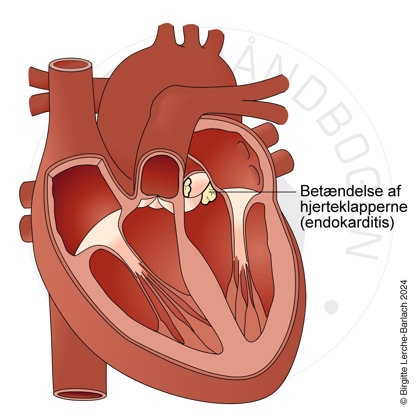 LH_hjerter 11_Endokarditis (002)