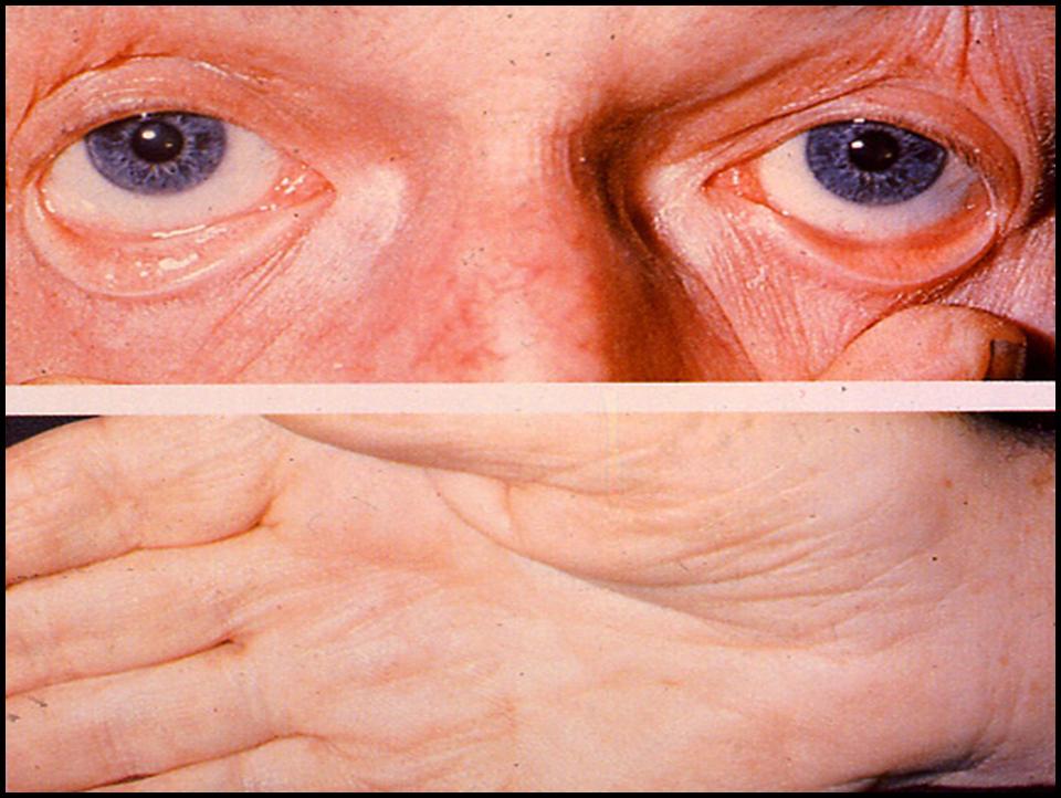 blege slimhinder og haandflader ved jernmangel