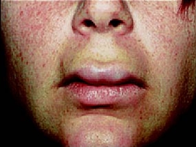 ansigt-angiooedem