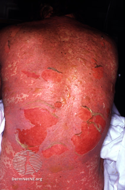 toksisk-epidermal-nekrolyse2