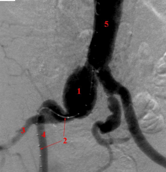 baekkenarterie-aneurisme-rgt